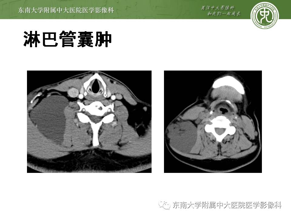 【病例】鳃裂囊肿VS甲状舌管囊肿1例CT