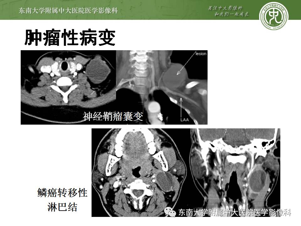 【病例】鳃裂囊肿VS甲状舌管囊肿1例CT