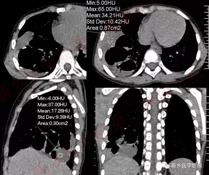 【病例】先天性囊性腺瘤样畸形1例CT影像表现