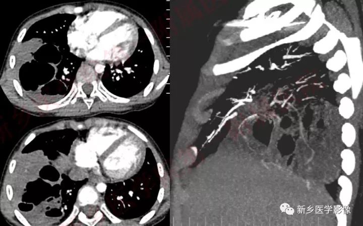 【病例】先天性囊性腺瘤样畸形1例CT影像表现