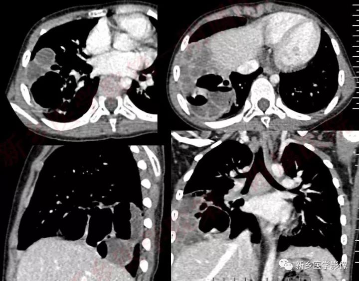 【病例】先天性囊性腺瘤样畸形1例CT影像表现