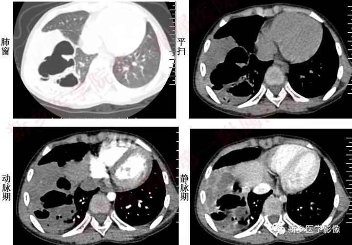 【病例】先天性囊性腺瘤样畸形1例CT影像表现