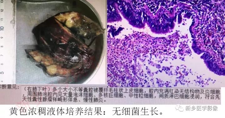 【病例】先天性囊性腺瘤样畸形1例CT影像表现