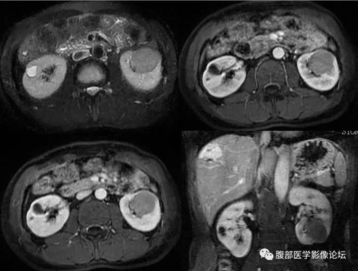 【病例】肾嫌色细胞癌1例MR影像表现 【病例】肾嫌色细胞癌1例MR影像表现