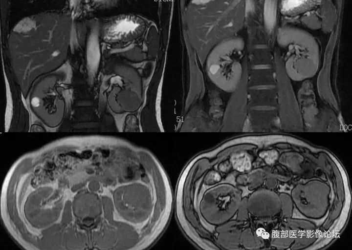 【病例】肾嫌色细胞癌1例MR影像表现 【病例】肾嫌色细胞癌1例MR影像表现