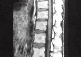 【病例】脊髓内结核1例MR影像表现 【病例】脊髓内结核1例MR影像表现