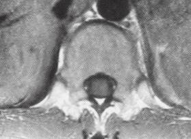 【病例】脊髓内结核1例MR影像表现 【病例】脊髓内结核1例MR影像表现