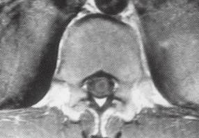 【病例】脊髓内结核1例MR影像表现 【病例】脊髓内结核1例MR影像表现