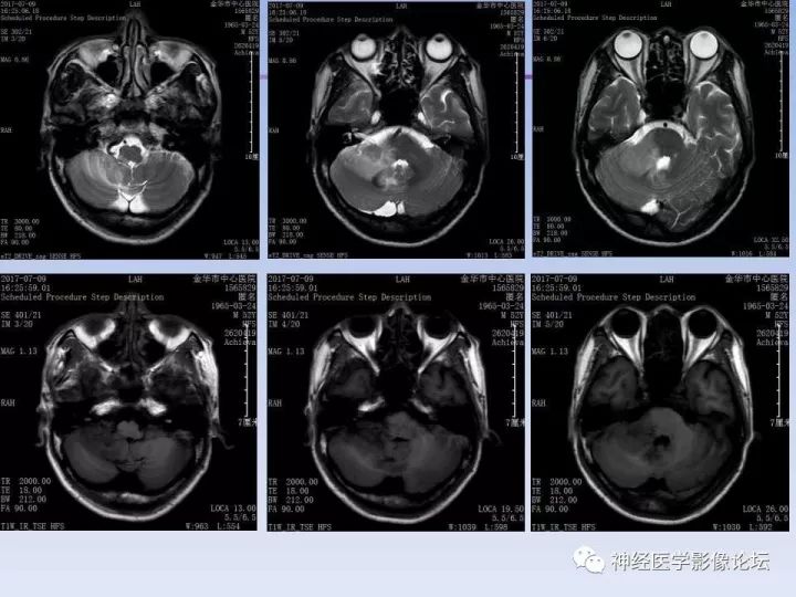 【病例】罕见高灌注的中枢神经系统淋巴瘤1例MR