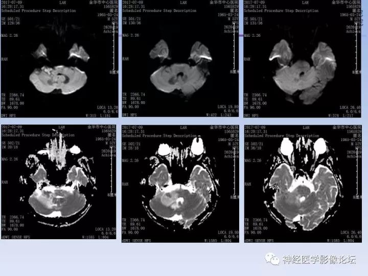 【病例】罕见高灌注的中枢神经系统淋巴瘤1例MR