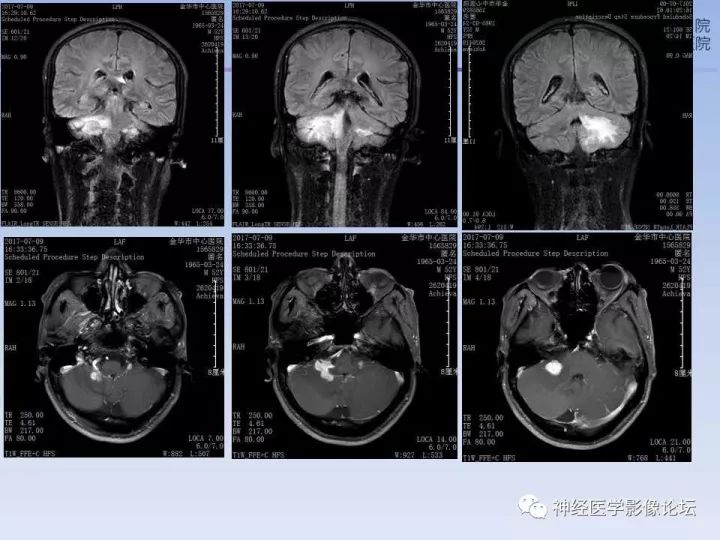 【病例】罕见高灌注的中枢神经系统淋巴瘤1例MR