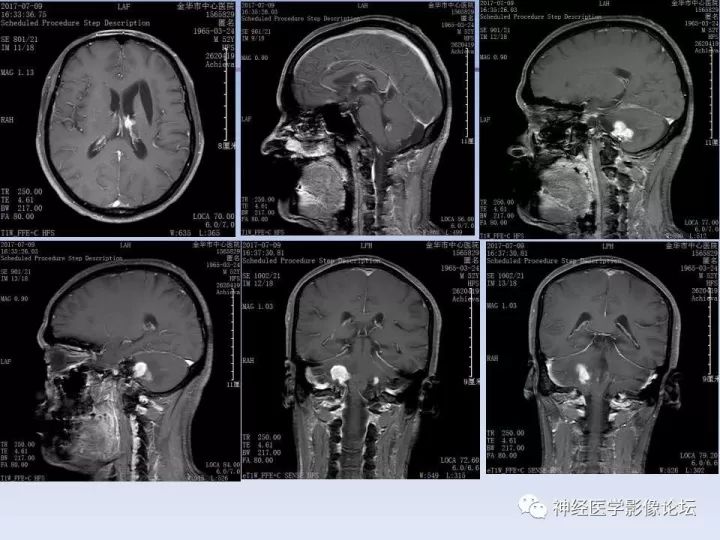 【病例】罕见高灌注的中枢神经系统淋巴瘤1例MR