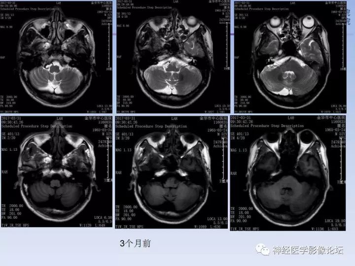 【病例】罕见高灌注的中枢神经系统淋巴瘤1例MR