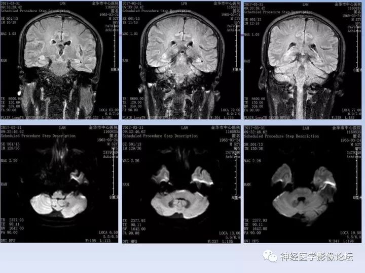 【病例】罕见高灌注的中枢神经系统淋巴瘤1例MR