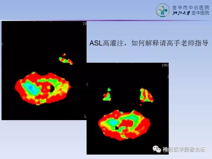 【病例】罕见高灌注的中枢神经系统淋巴瘤1例MR