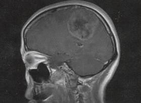 【病例】大脑镰软骨瘤1例MR影像表现 【病例】大脑镰软骨瘤1例MR影像表现