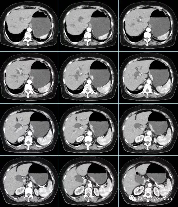 【病例】贲门高分化腺癌1例CT影像表现