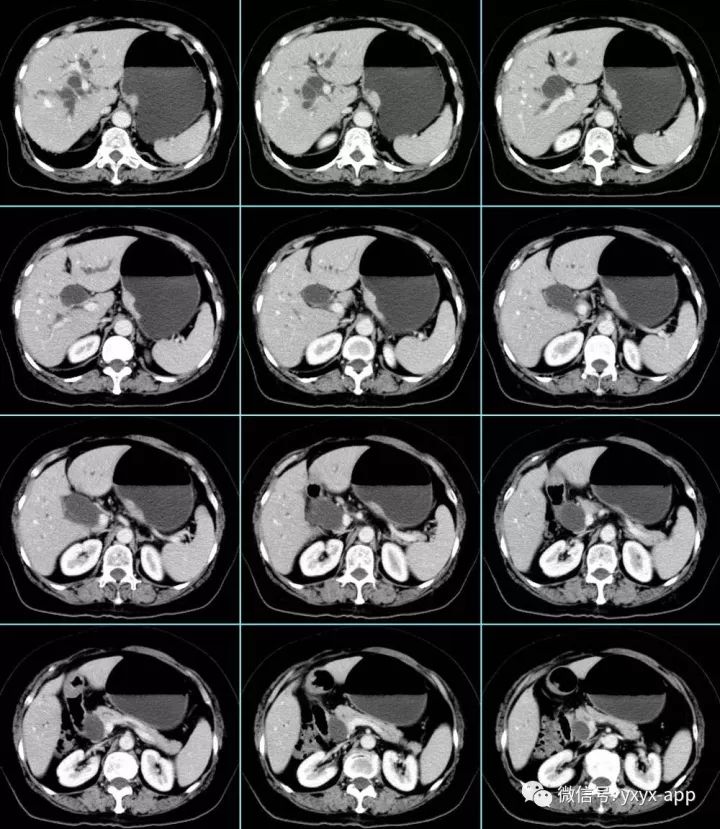 【病例】贲门高分化腺癌1例CT影像表现