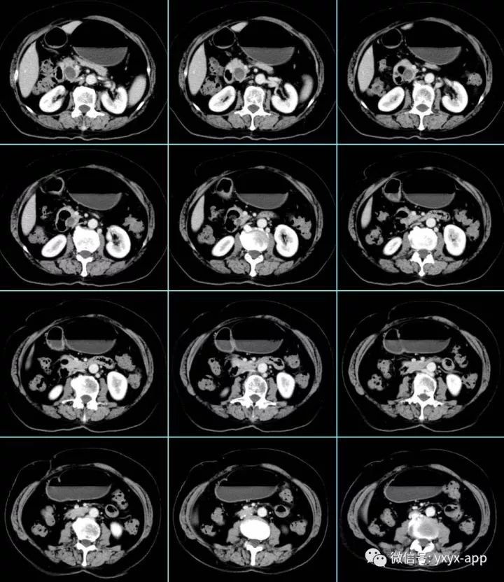 【病例】贲门高分化腺癌1例CT影像表现