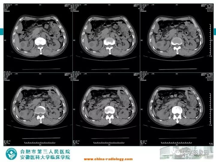 【病例】后肾腺瘤1例CT影像表现 【病例】后肾腺瘤1例CT影像表现