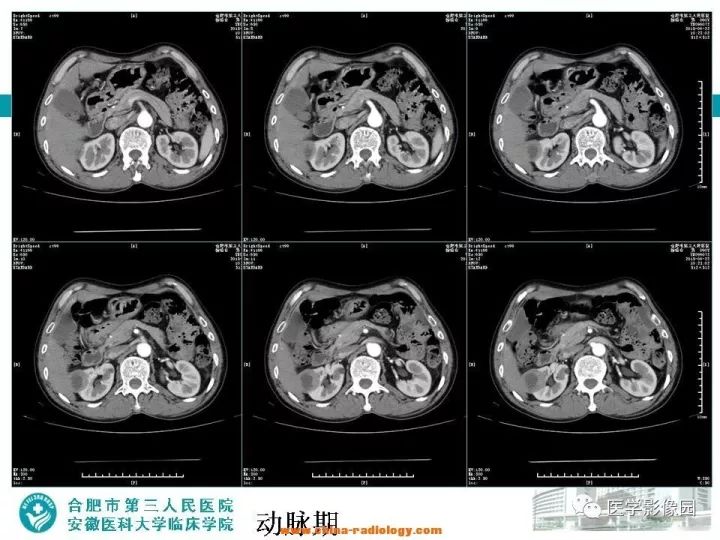 【病例】后肾腺瘤1例CT影像表现 【病例】后肾腺瘤1例CT影像表现