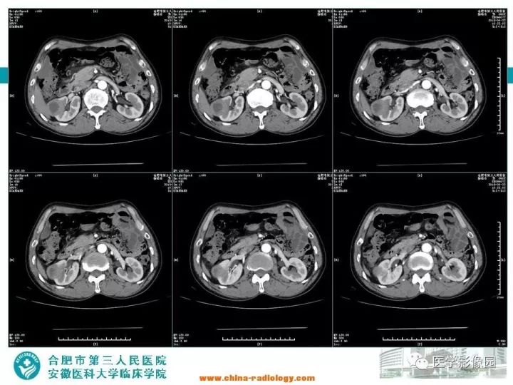 【病例】后肾腺瘤1例CT影像表现 【病例】后肾腺瘤1例CT影像表现