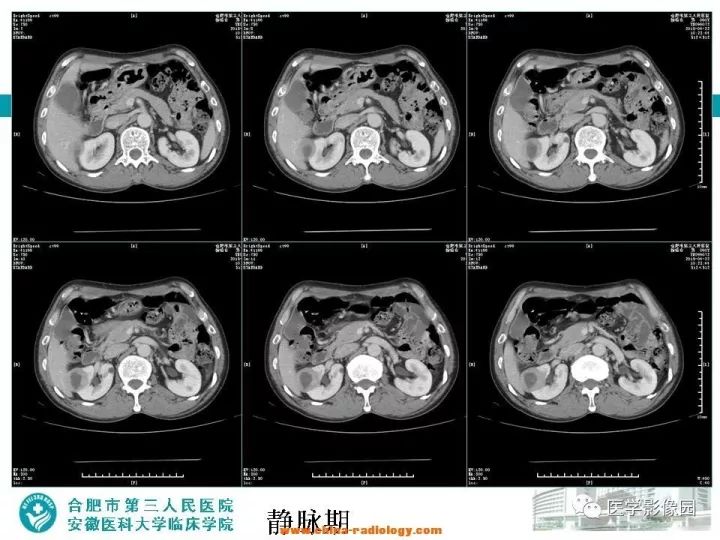 【病例】后肾腺瘤1例CT影像表现 【病例】后肾腺瘤1例CT影像表现