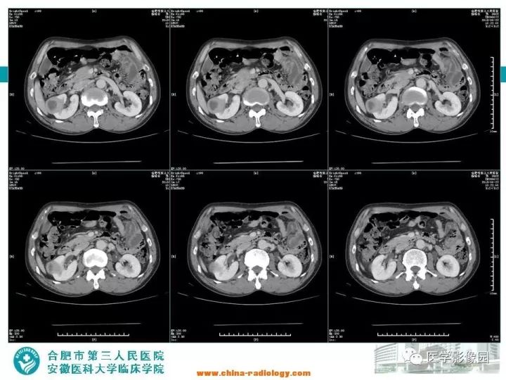 【病例】后肾腺瘤1例CT影像表现 【病例】后肾腺瘤1例CT影像表现