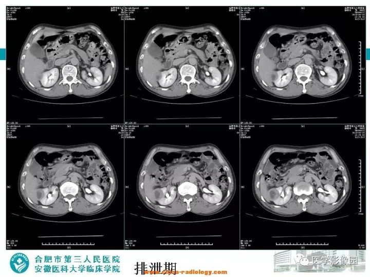 【病例】后肾腺瘤1例CT影像表现 【病例】后肾腺瘤1例CT影像表现