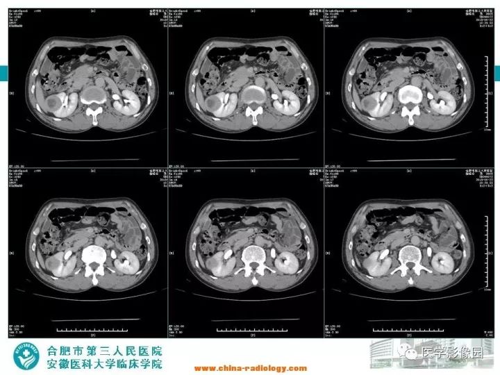 【病例】后肾腺瘤1例CT影像表现 【病例】后肾腺瘤1例CT影像表现
