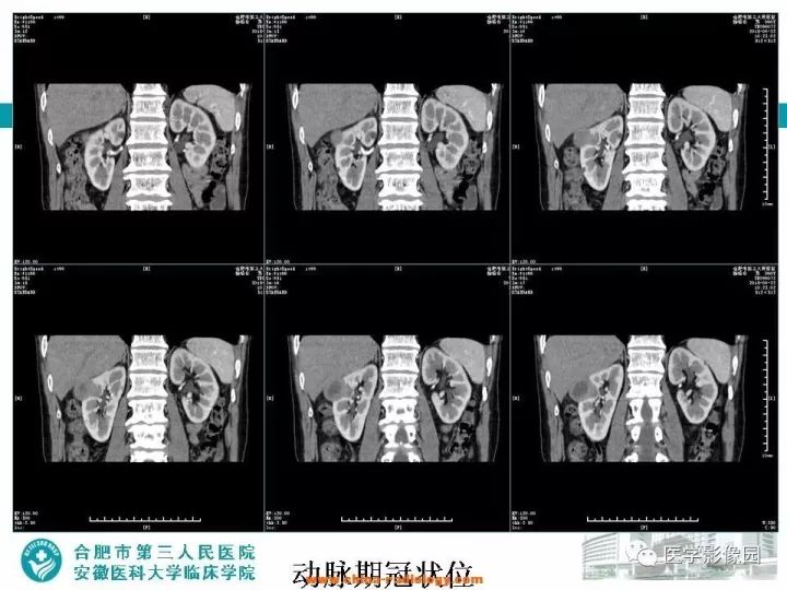【病例】后肾腺瘤1例CT影像表现 【病例】后肾腺瘤1例CT影像表现