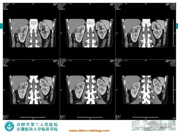 【病例】后肾腺瘤1例CT影像表现 【病例】后肾腺瘤1例CT影像表现