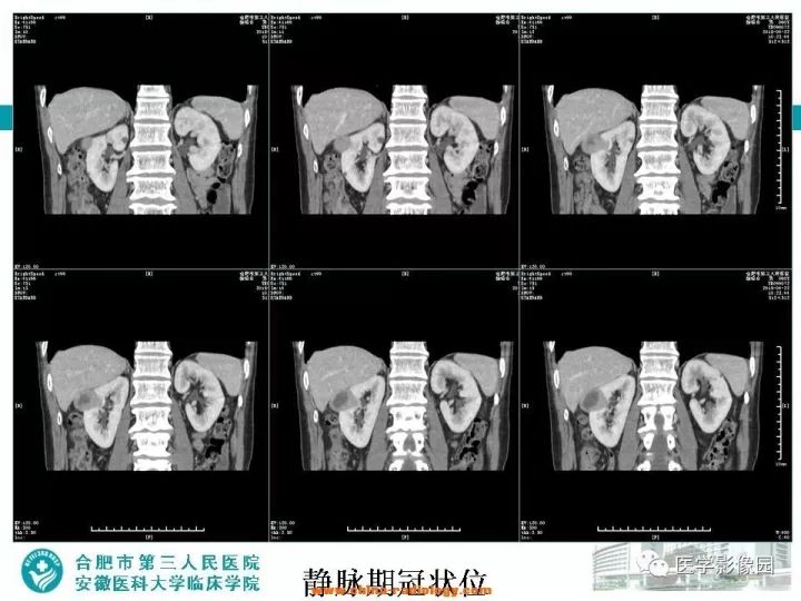 【病例】后肾腺瘤1例CT影像表现 【病例】后肾腺瘤1例CT影像表现