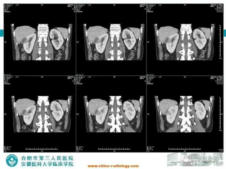【病例】后肾腺瘤1例CT影像表现