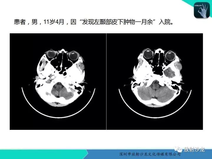 【病例】颞部腺泡状横纹肌肉瘤1例MR影像表现