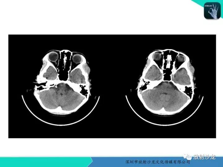 【病例】颞部腺泡状横纹肌肉瘤1例MR影像表现