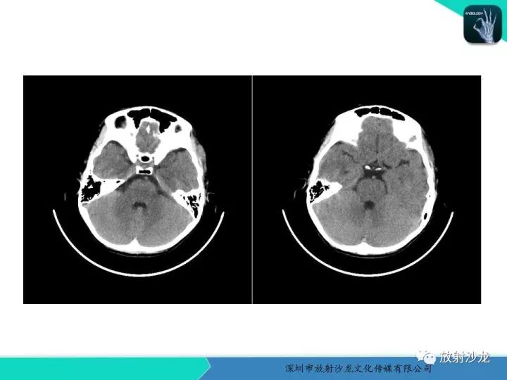 【病例】颞部腺泡状横纹肌肉瘤1例MR影像表现