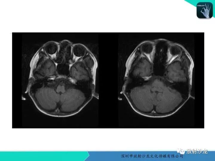 【病例】颞部腺泡状横纹肌肉瘤1例MR影像表现