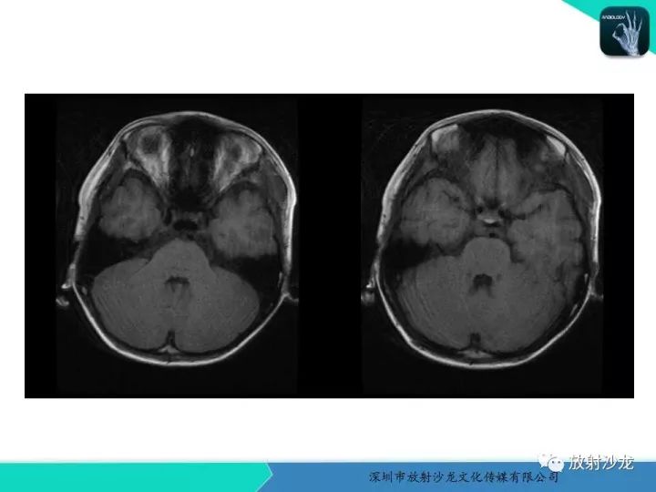 【病例】颞部腺泡状横纹肌肉瘤1例MR影像表现