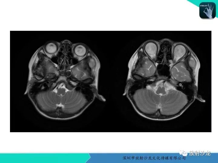 【病例】颞部腺泡状横纹肌肉瘤1例MR影像表现