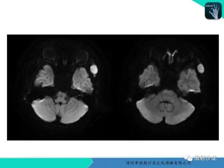 【病例】颞部腺泡状横纹肌肉瘤1例MR影像表现