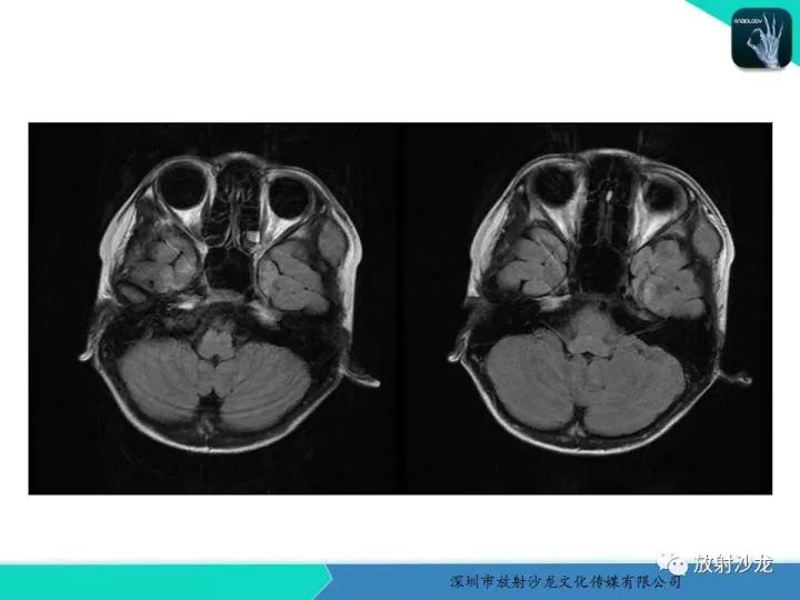 【病例】颞部腺泡状横纹肌肉瘤1例MR影像表现