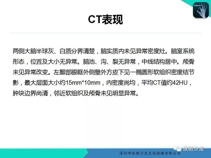 【病例】颞部腺泡状横纹肌肉瘤1例MR影像表现