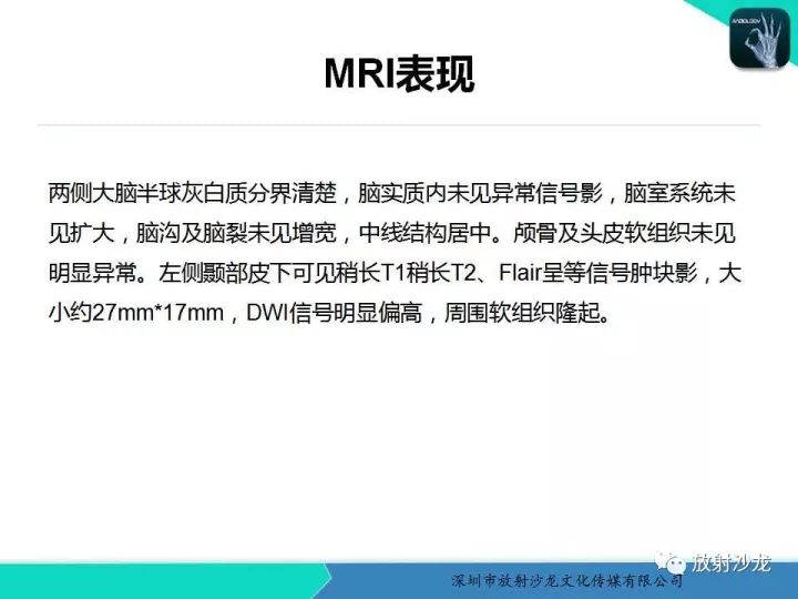 【病例】颞部腺泡状横纹肌肉瘤1例MR影像表现