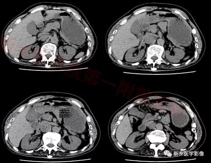 【病例】腹膜后嗜铬细胞瘤1例CT影像表现 【病例】腹膜后嗜铬细胞瘤1例CT影像表现