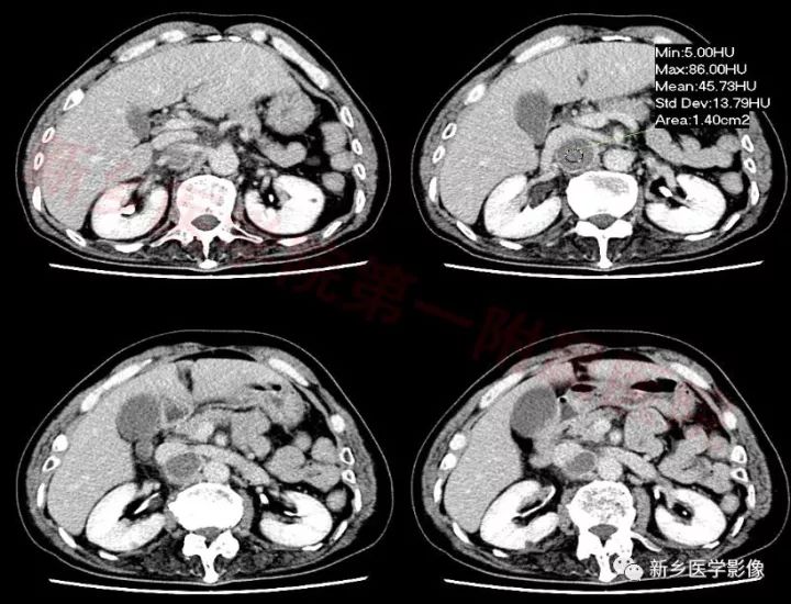 【病例】腹膜后嗜铬细胞瘤1例CT影像表现 【病例】腹膜后嗜铬细胞瘤1例CT影像表现