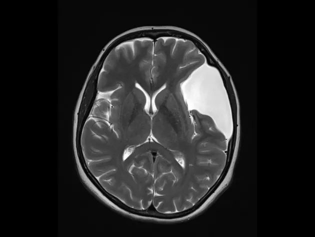 颅中窝蛛网膜囊肿的分型 颅中窝蛛网膜囊肿的分型