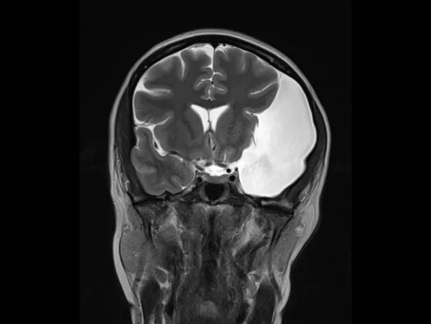 颅中窝蛛网膜囊肿的分型 颅中窝蛛网膜囊肿的分型