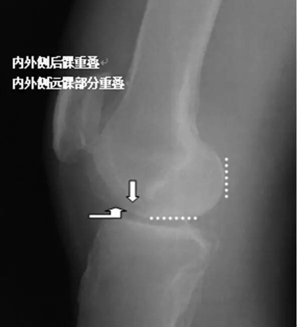 详细的膝关节X线解剖+解读+测量 详细的膝关节X线解剖+解读+测量