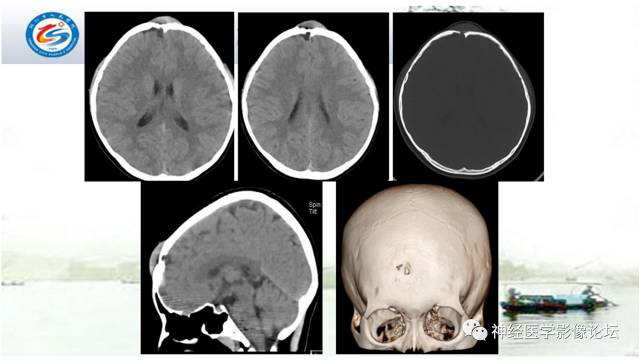 【病例】颅骨骨膜窦1例MR影像表现